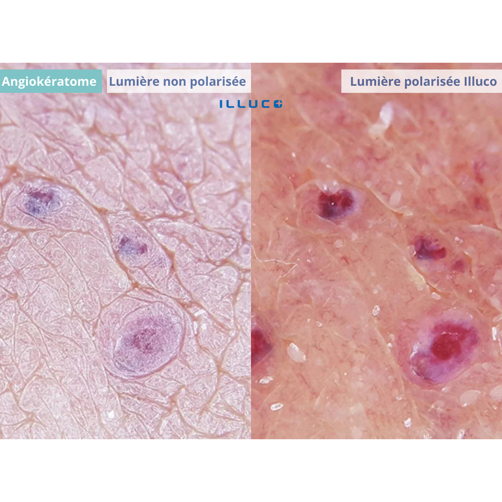 Dermatoscope rechargeable ILLUCO IDS-1100