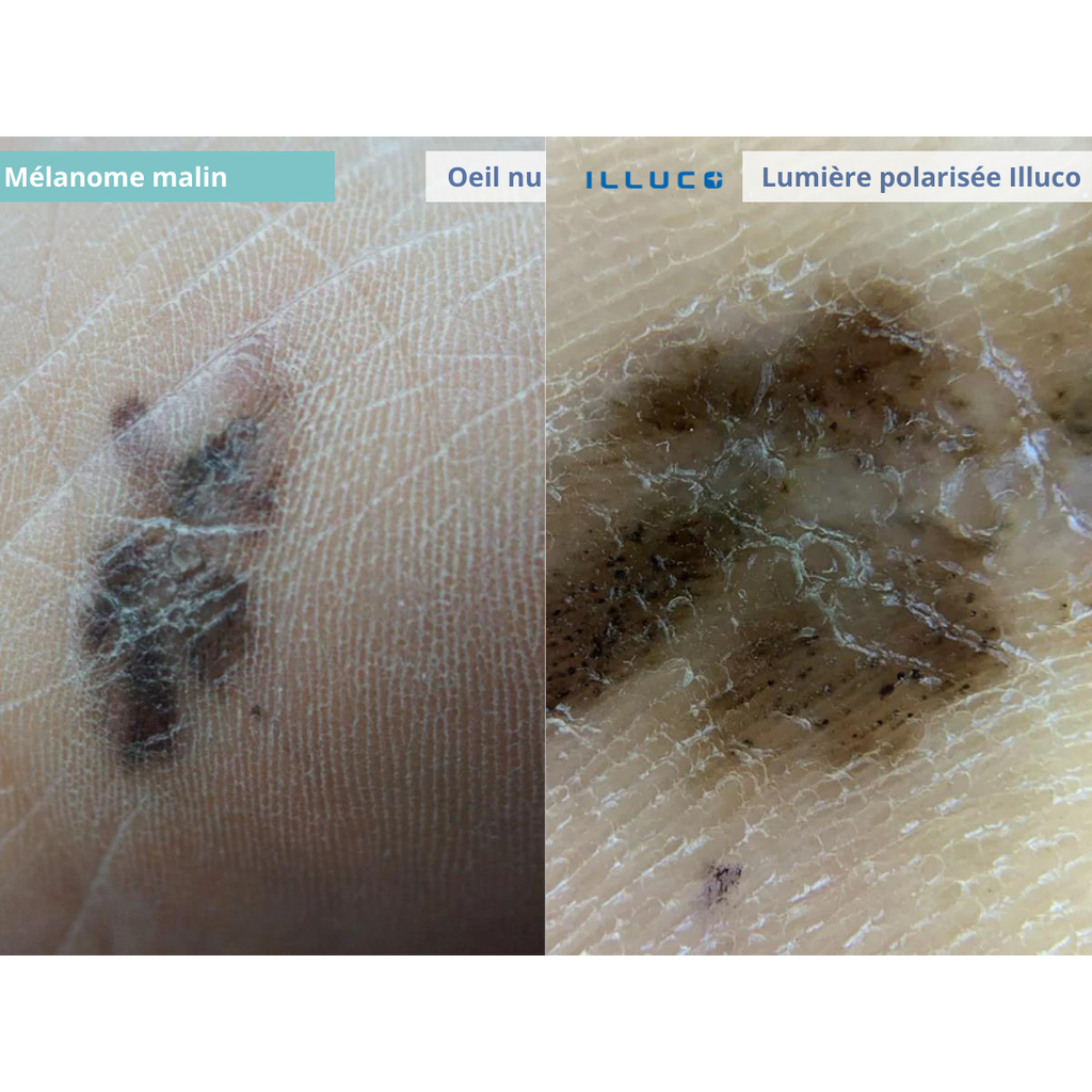 Dermatoscope rechargeable ILLUCO IDS-1100