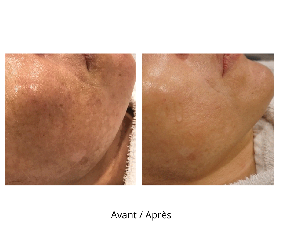 Dermaroller microneedling professionnel 18 rangées d’aiguilles avec profondeur de 2.5 mm