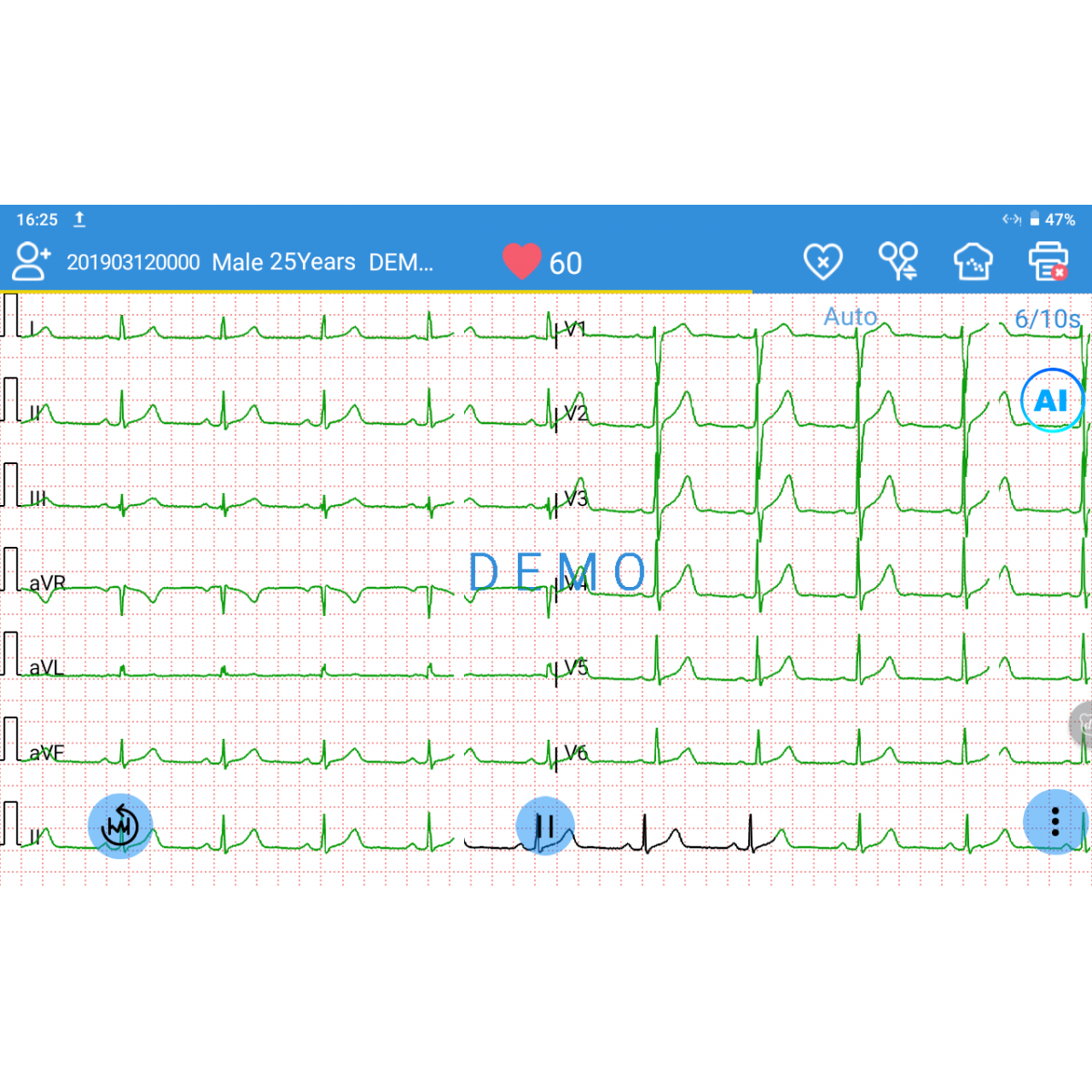 ECG EDAN SE-1200 Pro 12 pistes, tactile avec imprimante