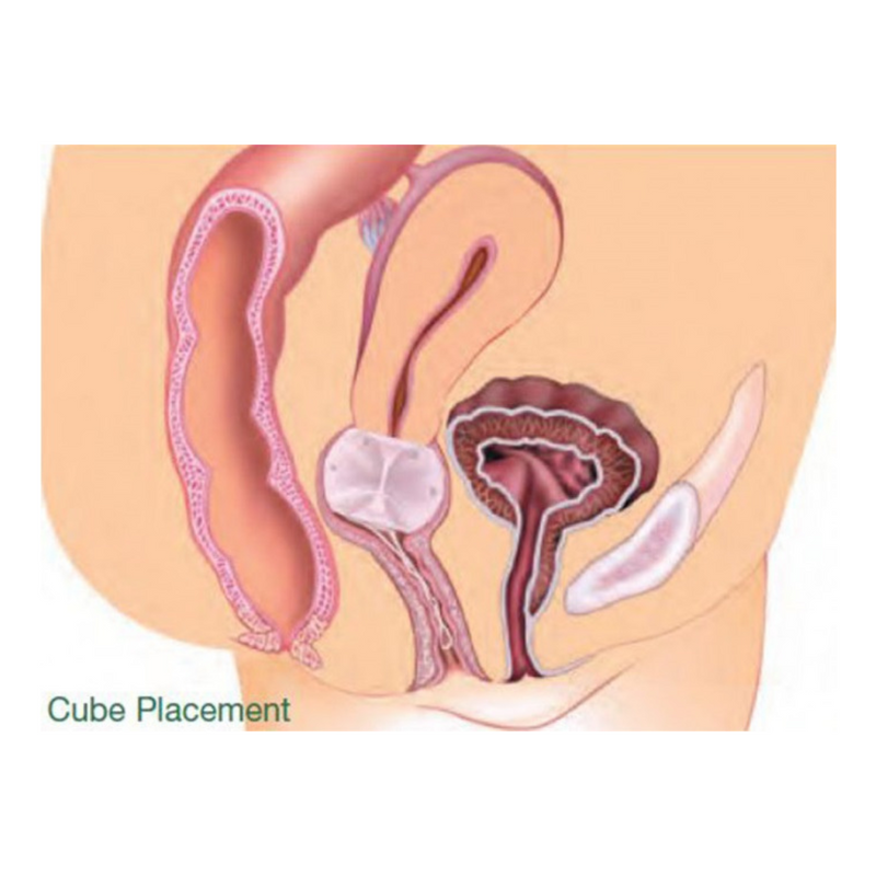Pessaire silicone Gyn&Cube - GYNEAS